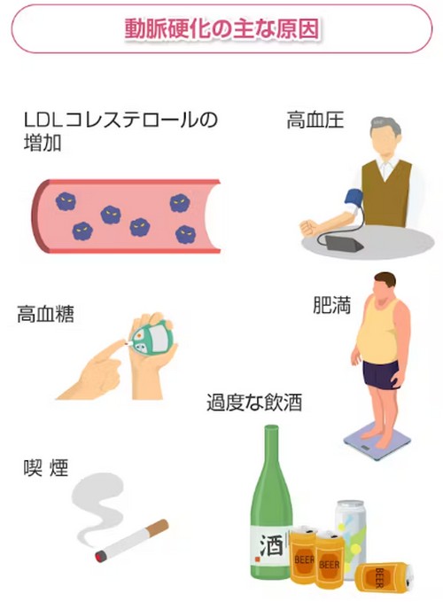 動脈硬化って?原因や進行を防ぐポイント!
