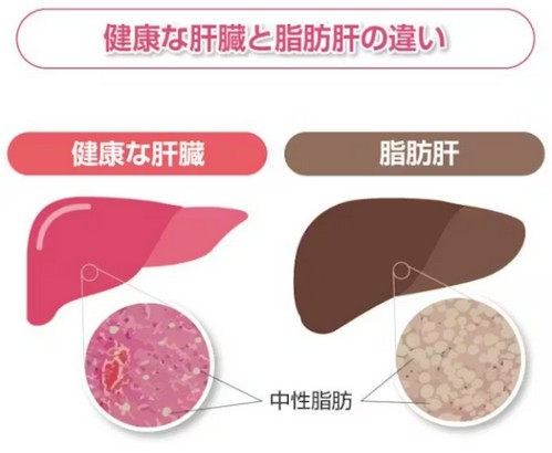 脂肪肝は大きな病気を引き起こす?改善法は!
