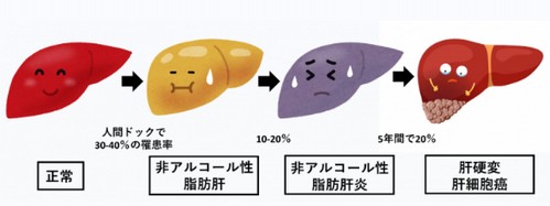 脂肪肝は大きな病気を引き起こす?改善法は!