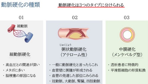 動脈硬化って?原因や進行を防ぐポイント!
