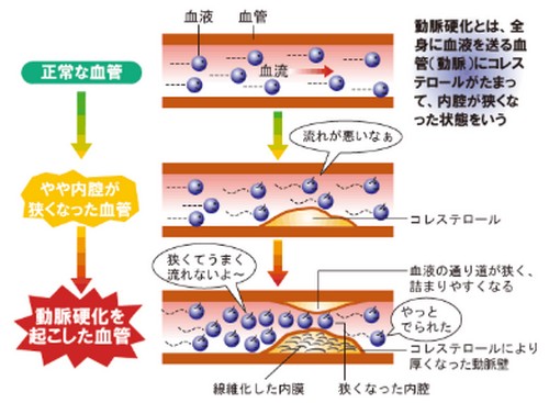動脈硬化って?原因や進行を防ぐポイント!