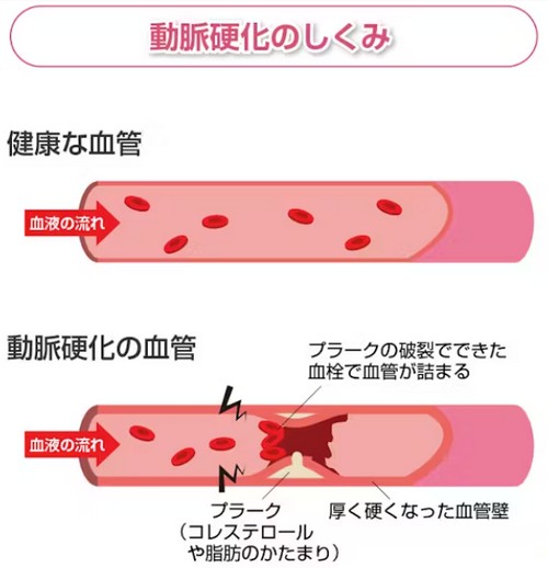 脂肪肝は大きな病気を引き起こす?改善法は!