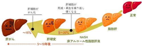 脂肪肝は大きな病気を引き起こす?改善法は!