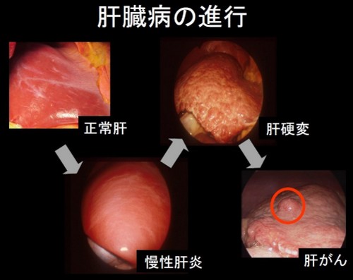 脂肪肝は大きな病気を引き起こす?改善法は!